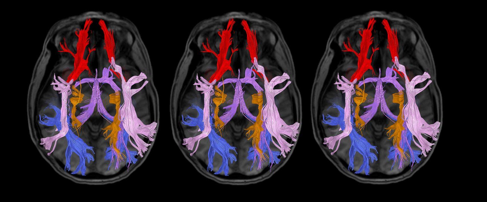 imagem de Plasticidade cerebral em foco