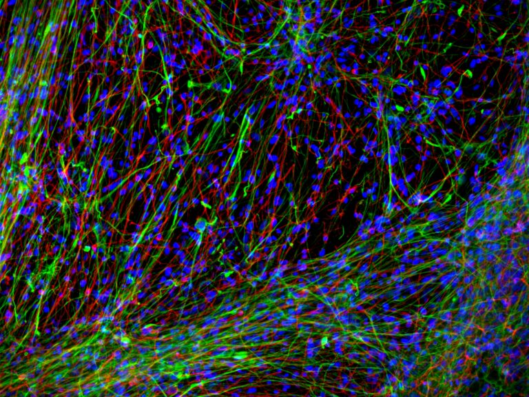 “Big Brother” celular: modelo 3D com células humanas permite observar metástases cerebrais em tempo real e abre caminho para novos tratamentos