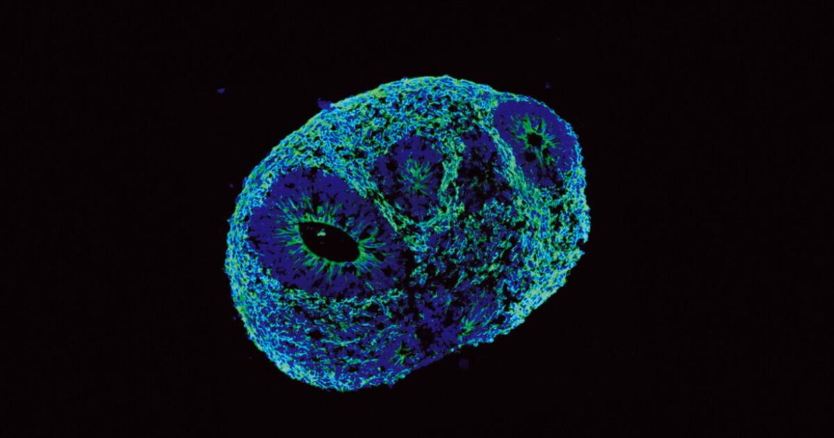 imagem de O cérebro antes da esquizofrenia