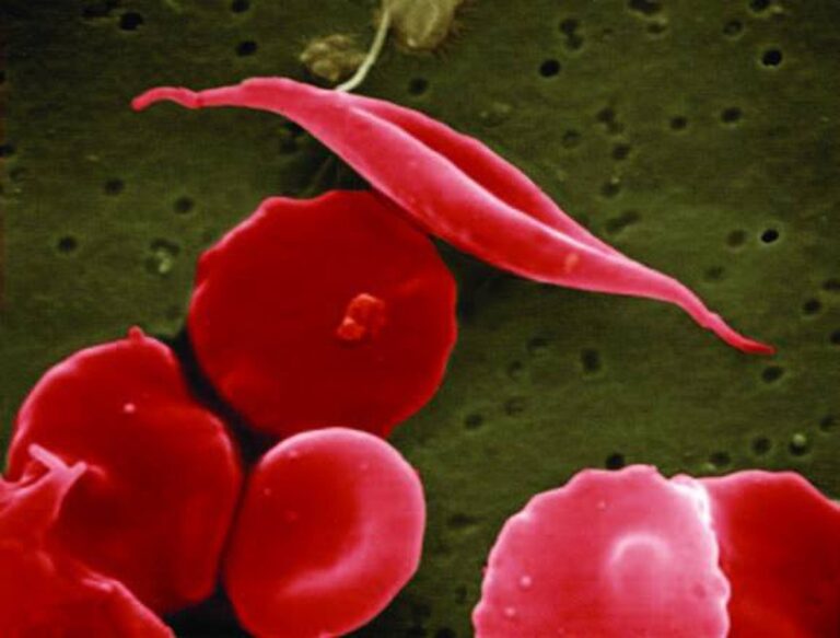 imagem de O Globo - Brasil estuda terapia gênica inovadora contra anemia falciforme para incorporar ao SUS
